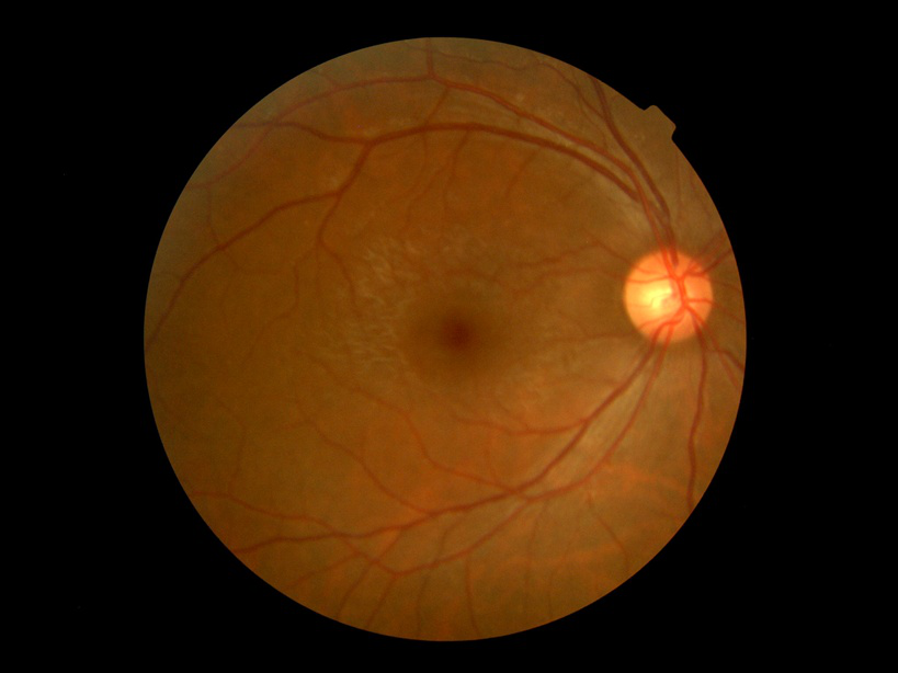 Pdr Grade DR Classification - AI-Powered Diabetic Retinopathy Analysis
